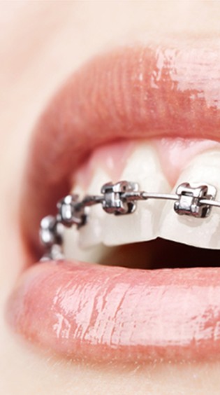 Ortodonzia Tradizionale - Studio dentistico dott. crinò giuseppe, Barcellona, Messina.